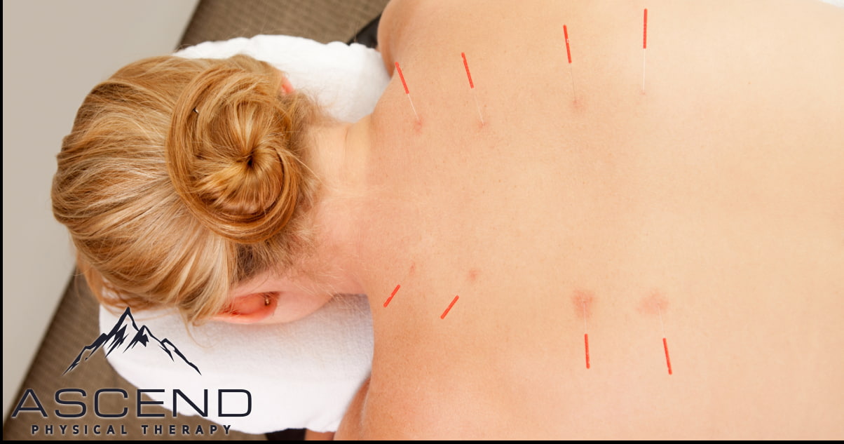 What is the Difference Between Dry Needling and Acupuncture?