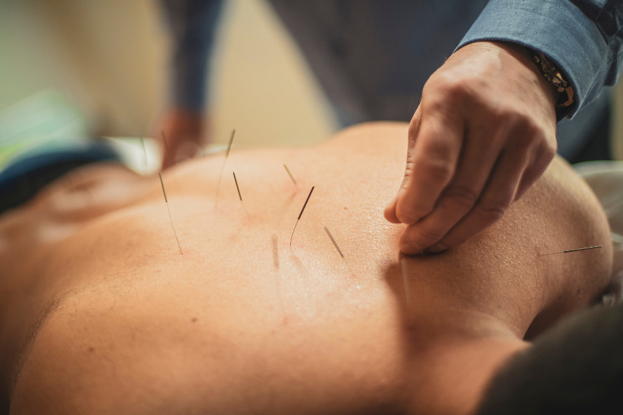 example of acupuncture